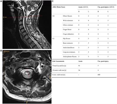 Evidence for reticulospinal plasticity underlying motor recovery in Brown-Séquard-plus Syndrome: a case report